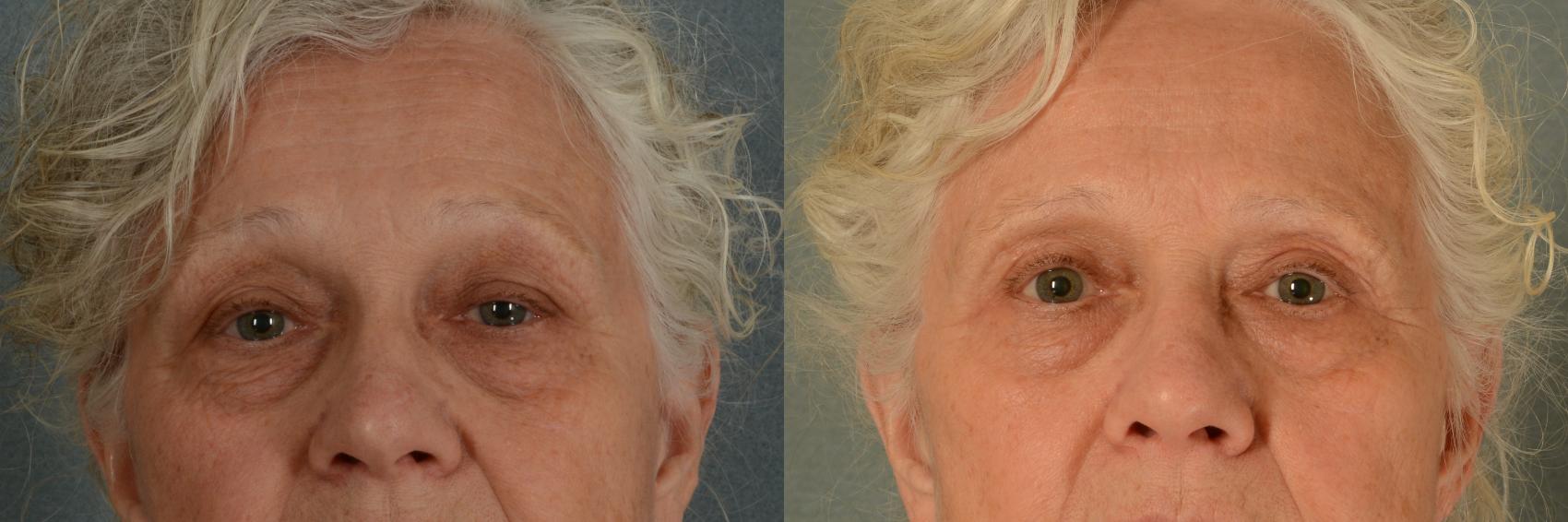 Before & After Oculoplastic Surgery Case 399 View #1 View in Tallahassee, FL