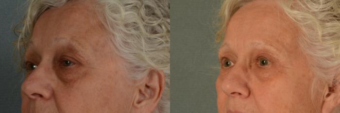 Before & After Oculoplastic Surgery Case 399 View #2 View in Tallahassee, FL