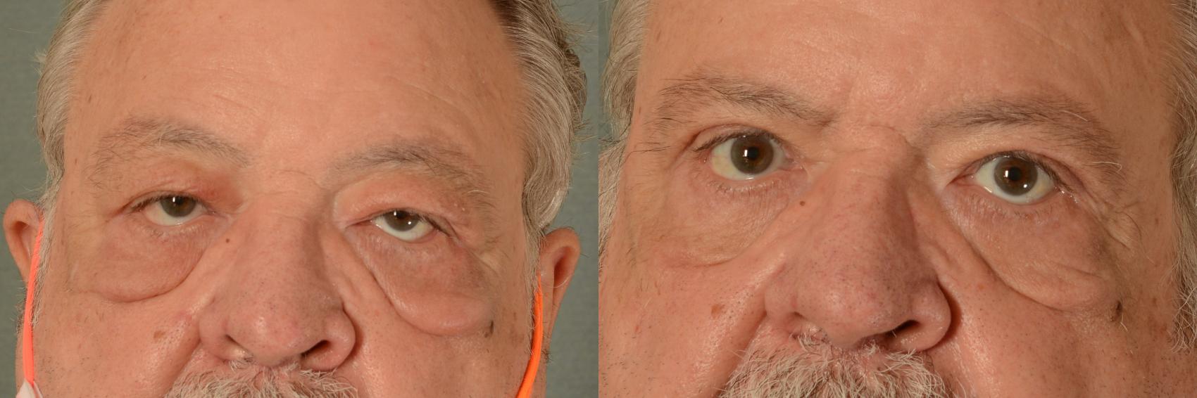 Before & After Oculoplastic Surgery Case 405 View #1 View in Tallahassee, FL