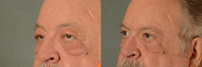 Before & After Oculoplastic Surgery Case 405 View #2 View in Tallahassee, FL