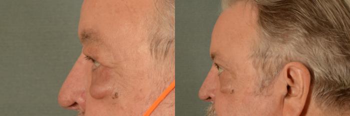Before & After Oculoplastic Surgery Case 405 View #3 View in Tallahassee, FL