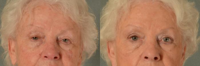 Before & After Oculoplastic Surgery Case 433 View #1 View in Tallahassee, FL