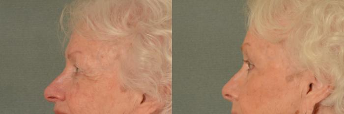 Before & After Oculoplastic Surgery Case 433 View #2 View in Tallahassee, FL