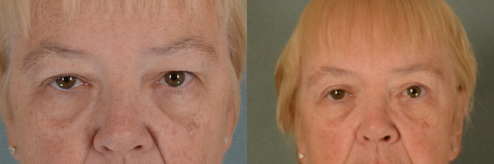 Before & After Eyelid Surgery (Blepharoplasty) Case 440 Front View in Tallahassee, FL