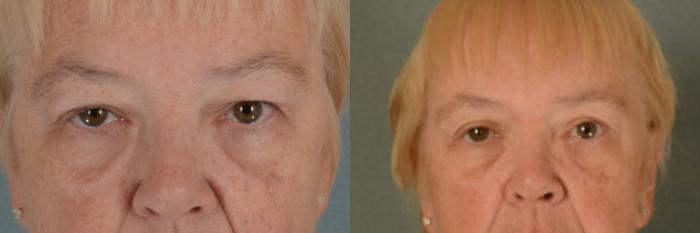 Before & After Eyelid Surgery (Blepharoplasty) Case 440 Front View in Tallahassee, FL