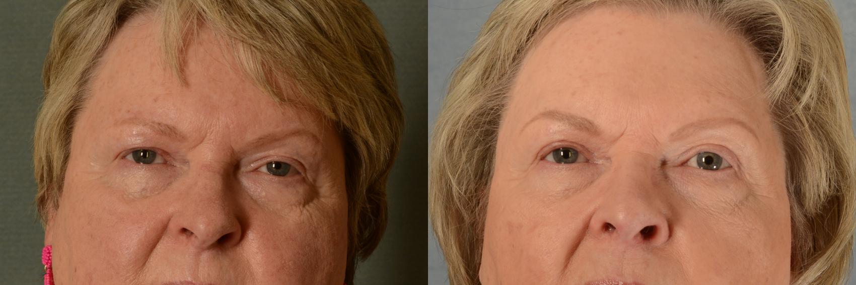 Before & After Oculoplastic Surgery Case 479 Front View in Tallahassee, FL