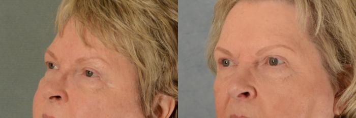 Before & After Oculoplastic Surgery Case 479 Left Oblique View in Tallahassee, FL