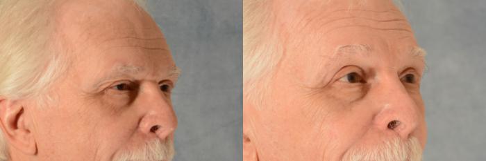 Before & After Oculoplastic Surgery Case 485 Right Oblique View in Tallahassee, FL