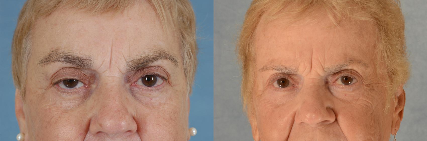 Before & After Oculoplastic Surgery Case 491 Front View in Tallahassee, FL