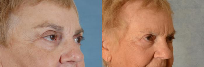 Before & After Oculoplastic Surgery Case 491 Right Oblique View in Tallahassee, FL