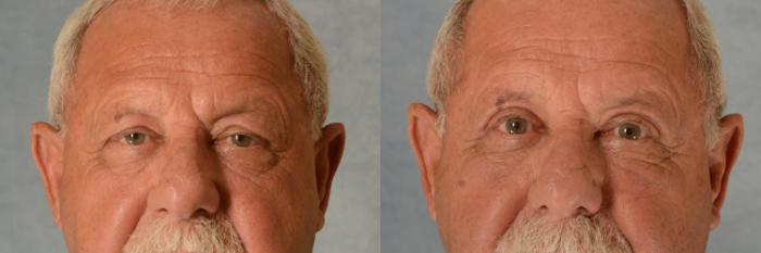 Before & After Oculoplastic Surgery Case 508 Front View in Tallahassee, FL