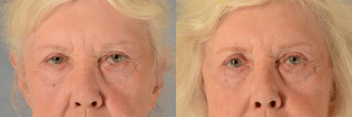 Before & After Oculoplastic Surgery Case 530 Front View in Tallahassee, FL