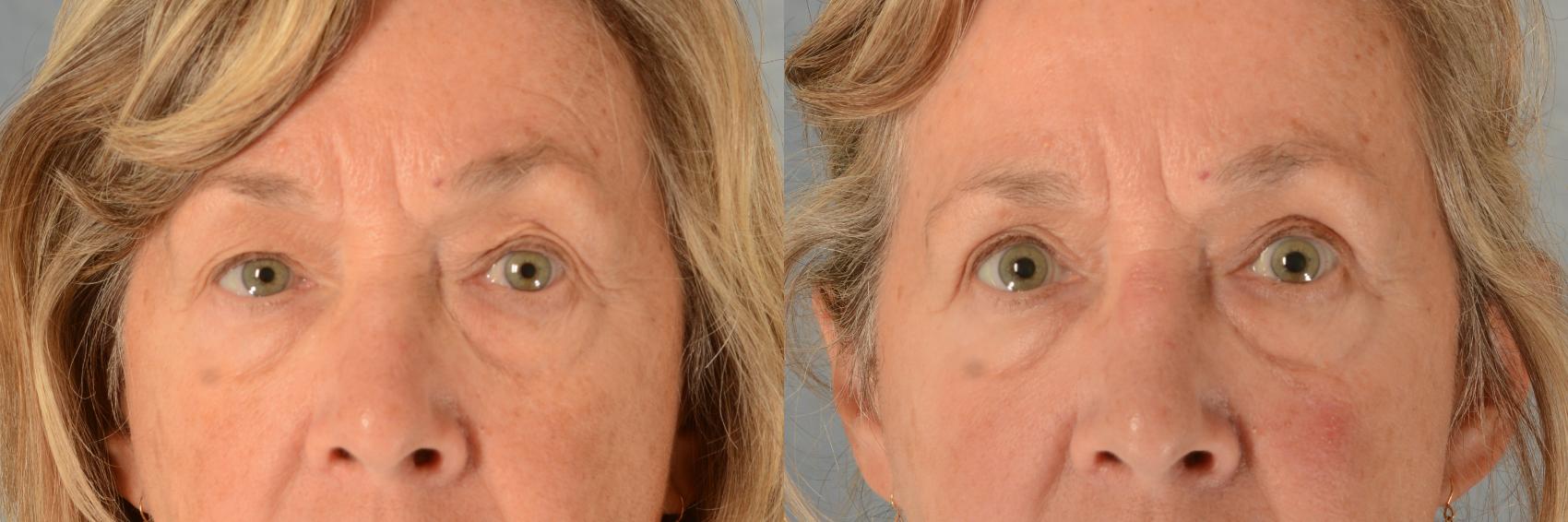 Before & After Oculoplastic Surgery Case 533 Front View in Tallahassee, FL