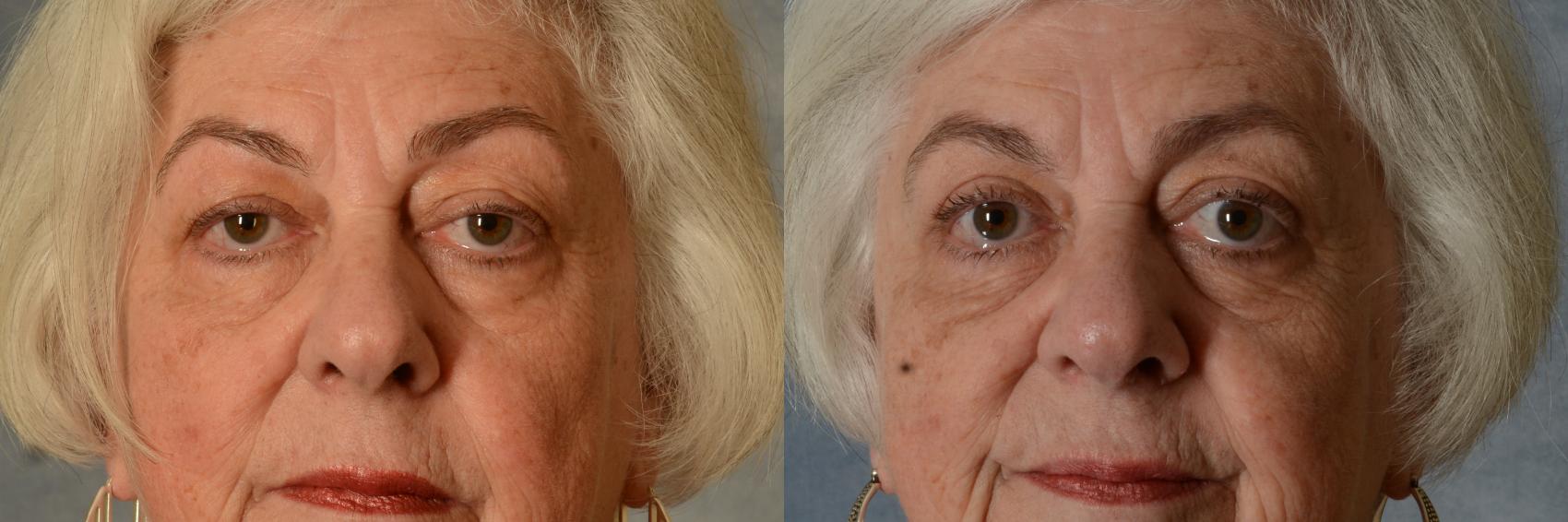 Before & After Oculoplastic Surgery Case 589 Front View in Tallahassee, FL