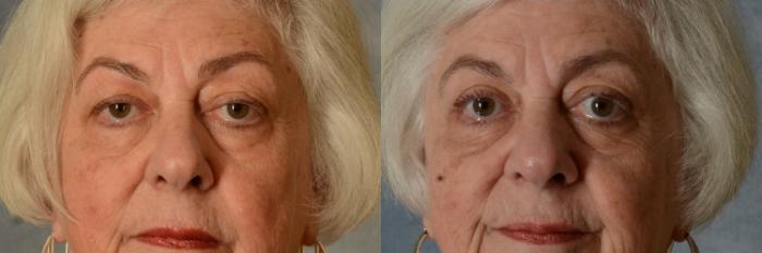 Before & After Oculoplastic Surgery Case 589 Front View in Tallahassee, FL