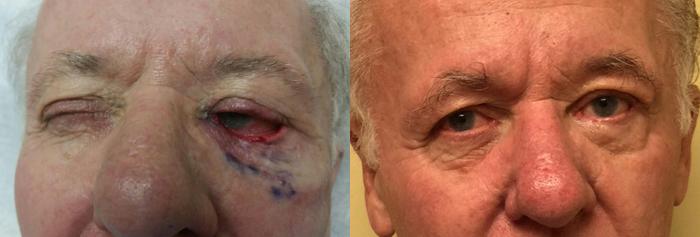 Before & After Oculoplastic Surgery Case 63 View #1 View in Tallahassee, FL