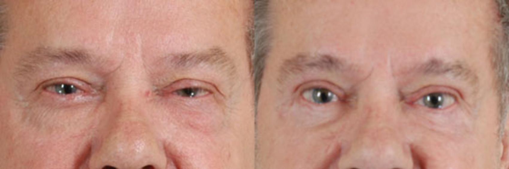 Before & After Oculoplastic Surgery Case 64 View #1 View in Tallahassee, FL