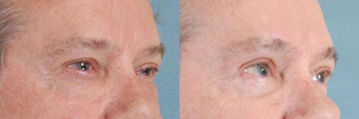 Before & After Oculoplastic Surgery Case 64 View #2 View in Tallahassee, FL