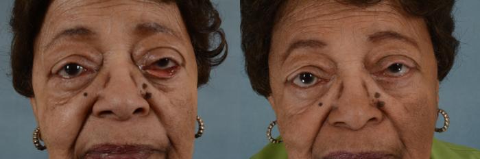 Before & After Oculoplastic Surgery Case 67 View #1 View in Tallahassee, FL