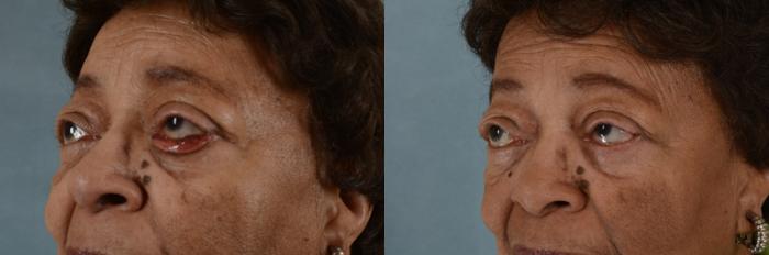 Before & After Oculoplastic Surgery Case 67 View #2 View in Tallahassee, FL