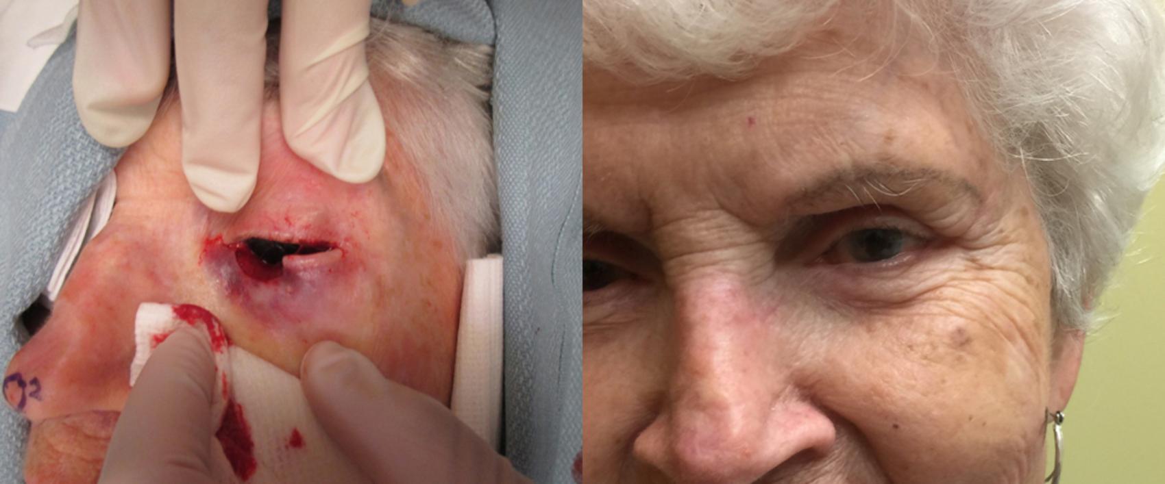 Before & After Oculoplastic Surgery Case 68 View #1 View in Tallahassee, FL