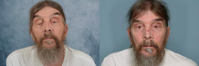 Before & After Oculoplastic Surgery Case 680 Front View in Tallahassee, FL