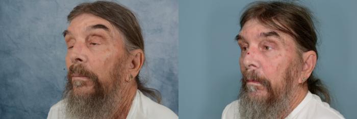 Before & After Oculoplastic Surgery Case 680 Left Oblique View in Tallahassee, FL