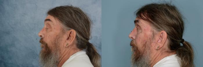 Before & After Oculoplastic Surgery Case 680 Left Side View in Tallahassee, FL