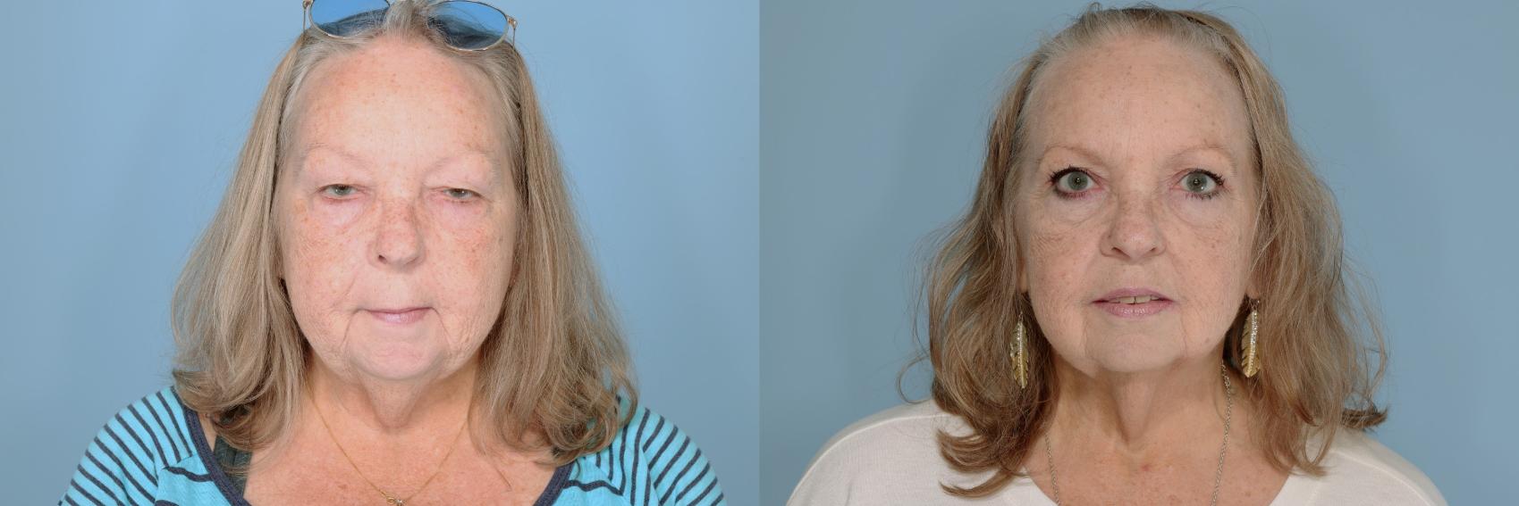 Before & After Oculoplastic Surgery Case 682 Front View in Tallahassee, FL