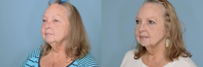 Before & After Oculoplastic Surgery Case 682 Left Oblique View in Tallahassee, FL