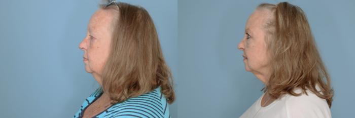 Before & After Oculoplastic Surgery Case 682 Left Side View in Tallahassee, FL