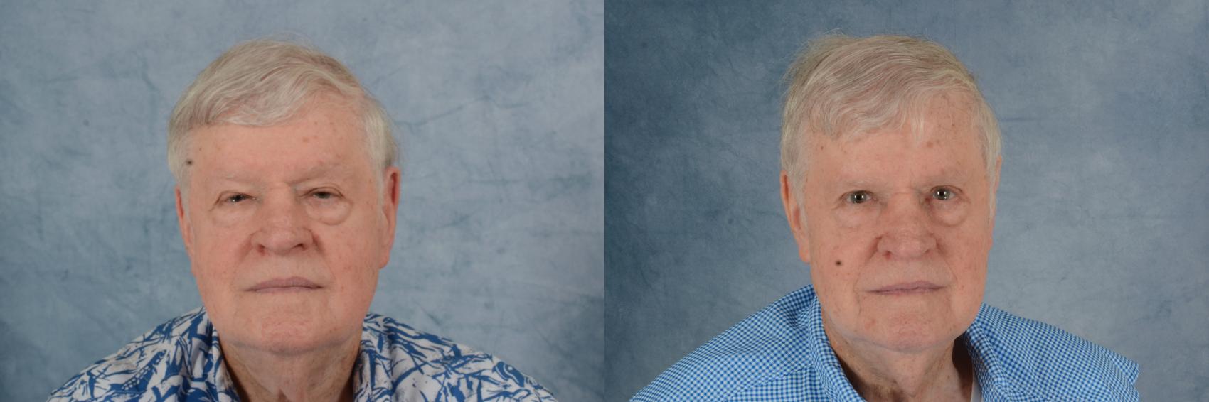 Before & After Oculoplastic Surgery Case 683 Front View in Tallahassee, FL