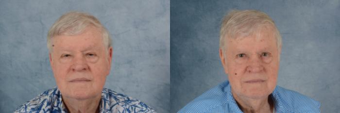 Before & After Oculoplastic Surgery Case 683 Front View in Tallahassee, FL