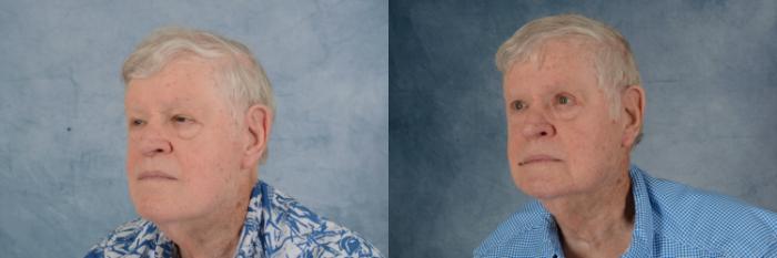 Before & After Oculoplastic Surgery Case 683 Left Oblique View in Tallahassee, FL