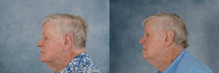 Before & After Oculoplastic Surgery Case 683 Left Side View in Tallahassee, FL