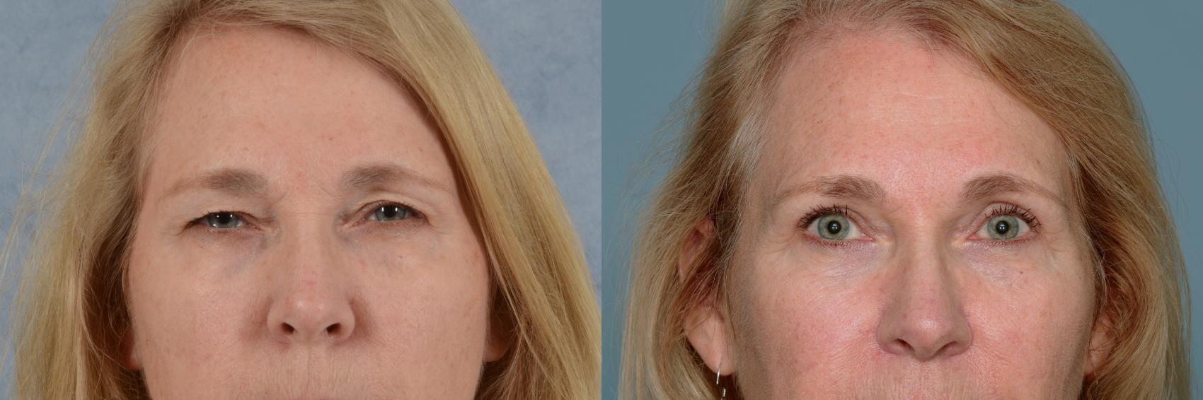 Before & After Oculoplastic Surgery Case 707 Front View in Tallahassee, FL