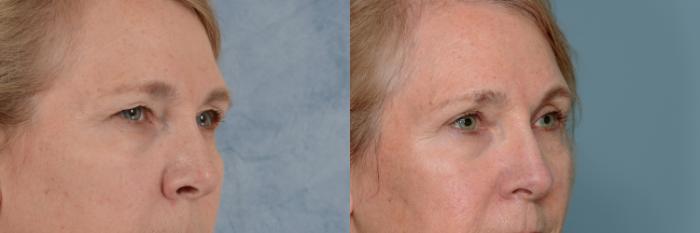 Before & After Oculoplastic Surgery Case 707 Right Oblique View in Tallahassee, FL
