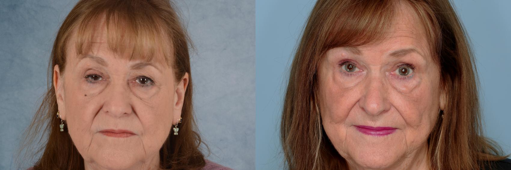 Before & After Oculoplastic Surgery Case 710 Front View in Tallahassee, FL