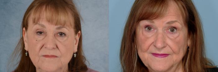 Before & After Oculoplastic Surgery Case 710 Front View in Tallahassee, FL