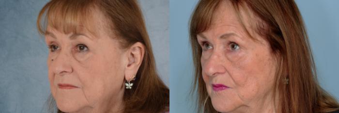 Before & After Oculoplastic Surgery Case 710 Left Side View in Tallahassee, FL