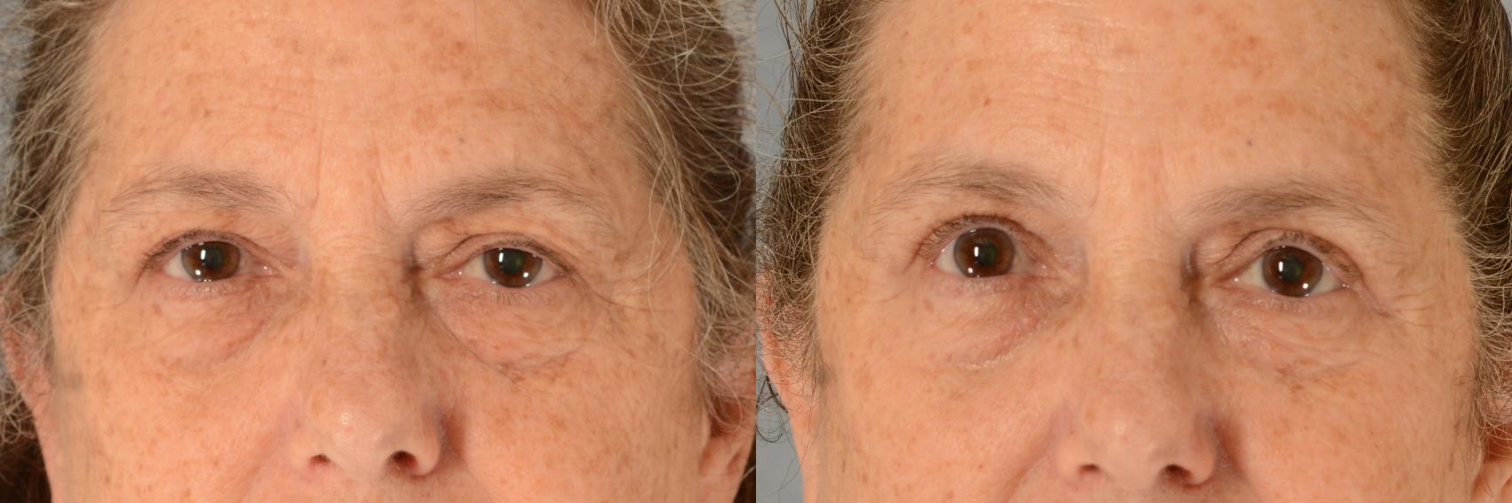 Before & After Oculoplastic Surgery Case 733 Front View in Tallahassee, FL