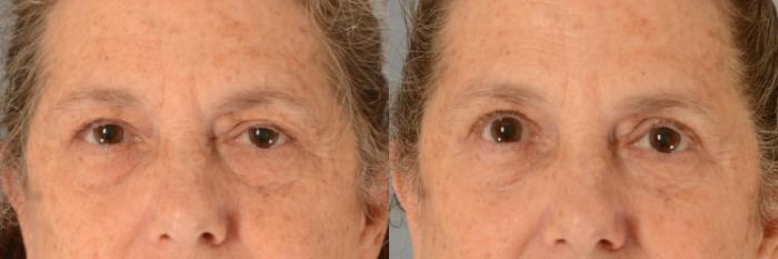 Before & After Oculoplastic Surgery Case 733 Front View in Tallahassee, FL