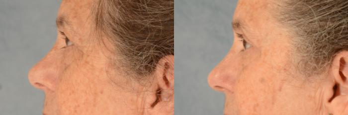 Before & After Oculoplastic Surgery Case 733 Left Side View in Tallahassee, FL