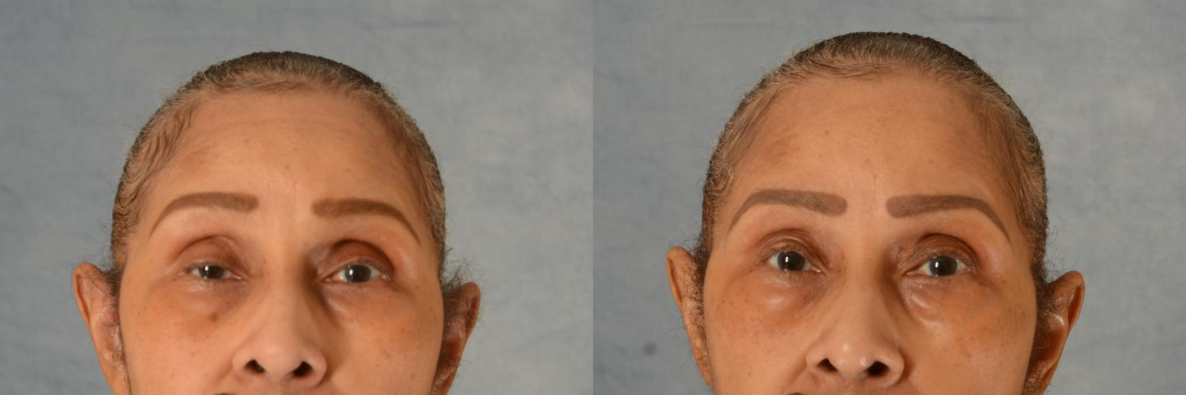 Before & After Oculoplastic Surgery Case 735 Front View in Tallahassee, FL