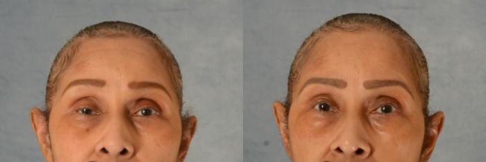 Before & After Oculoplastic Surgery Case 735 Front View in Tallahassee, FL