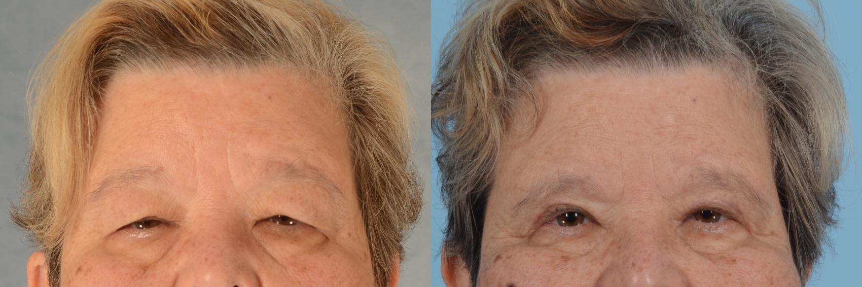 Before & After Oculoplastic Surgery Case 746 Front View in Tallahassee, FL