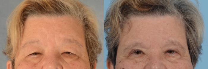 Before & After Oculoplastic Surgery Case 746 Front View in Tallahassee, FL
