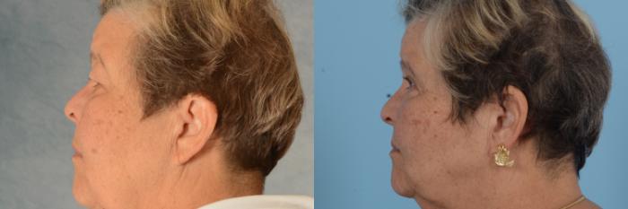 Before & After Oculoplastic Surgery Case 746 Left Side View in Tallahassee, FL
