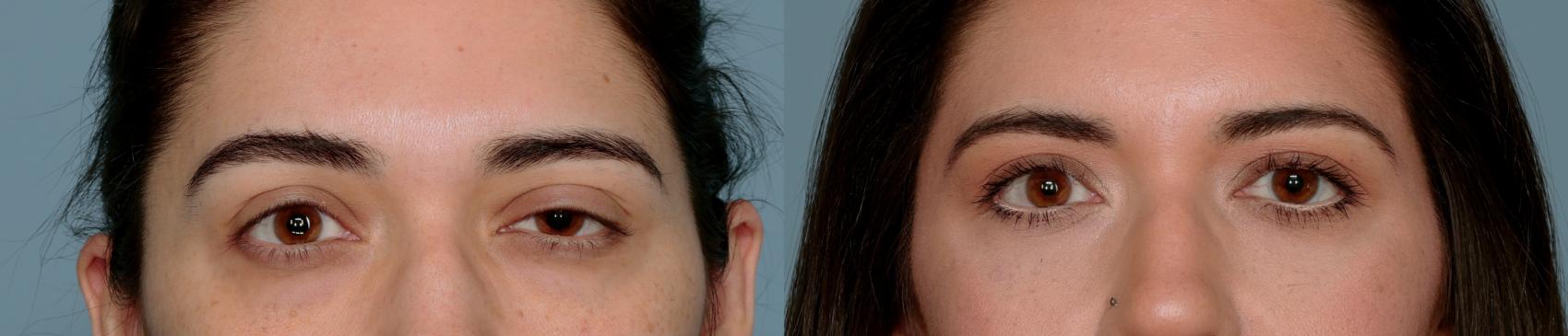 Before & After Oculoplastic Surgery Case 757 Front View in Tallahassee, FL