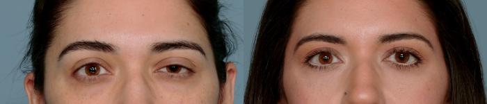 Before & After Oculoplastic Surgery Case 757 Front View in Tallahassee, FL